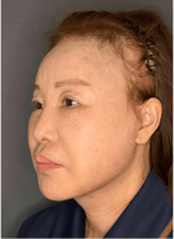 Post-operative photograph, oblique view