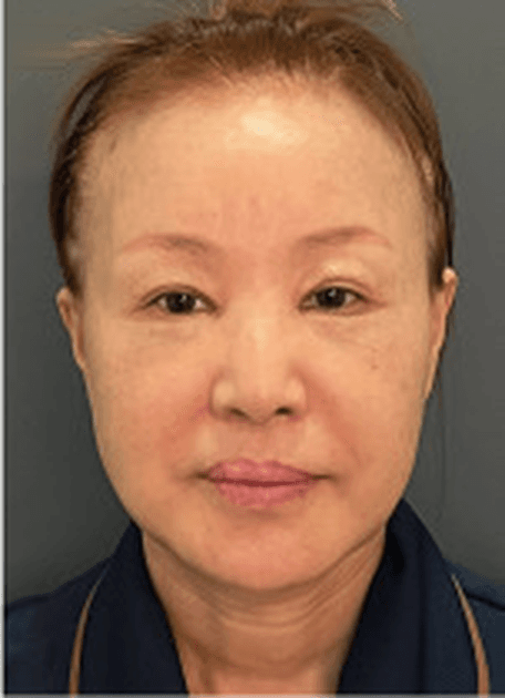 Frontal pre-operative photograph, case series 01