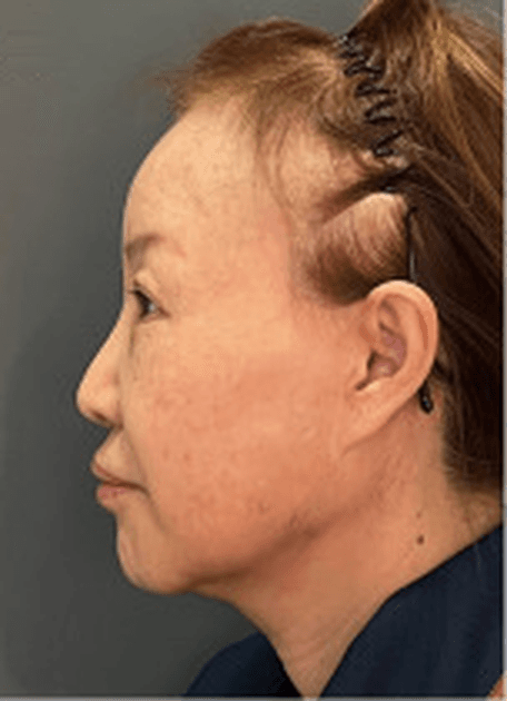 Left lateral pre-operative photograph, case series 01