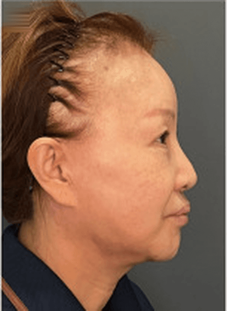 Right lateral pre-operative photograph, case series 01
